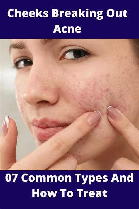 Cheeks Breaking Out Acne 7 Common Types And How To Treat Cheek Acne Cheek Pimples Acne