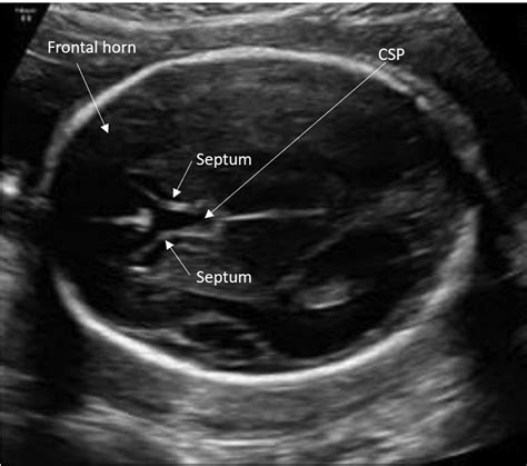 Absent Cavum Septi Pellucidi American Journal Of Obstetrics And Gynecology