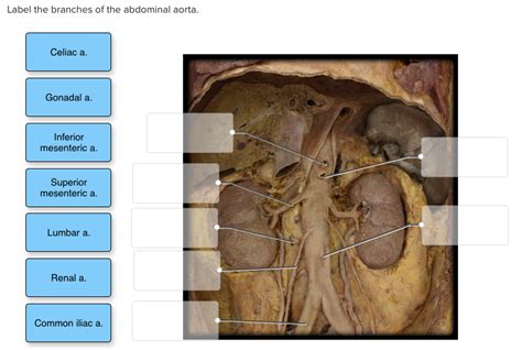 Solved Label The Branches Of The Abdominal Aorta Celiac