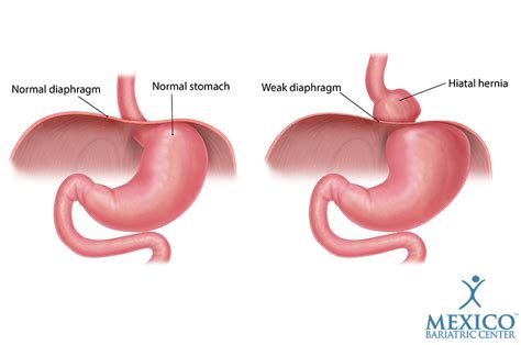 Hiatal Hernia Repair Gerd And Acid Reflux Mexico Bariatric Center