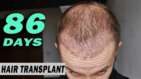 FUE Hair Transplant DAY 86 Post Op Istanbul Turkey GROWTH STAGE