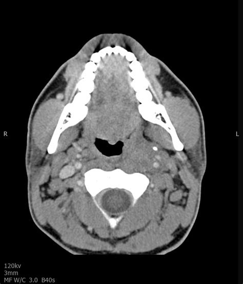 Pharyngeal Neck And Facial Infections Wisdom In Diagnostic Imaging