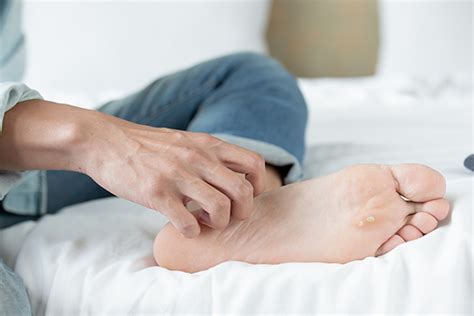 Foot Rashes Causes Treatment And Home Remedies