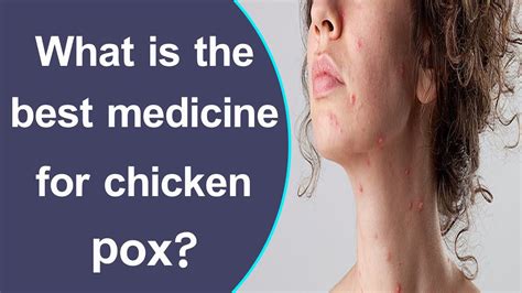 What Is The Best Medicine For Chicken Pox Youtube