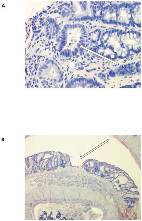 Histologic Appearance Of An Endoscopic Biopsy And Whole Colon Specimen