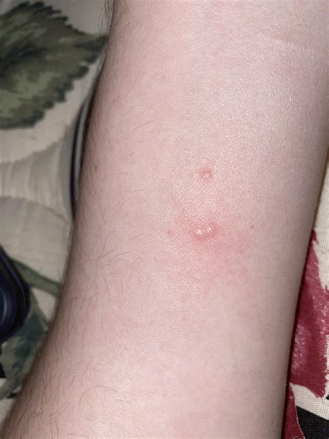 Have Weird Rash On My Forearm Anyone Know What This Is