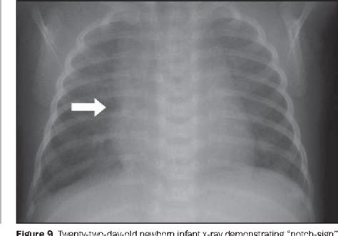 Figure 9 From Normal Findings On Chest X Rays Of Neonates Semantic