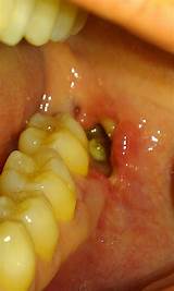Should You Use Mouthwash After Wisdom Teeth Removal Photos