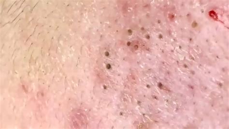 🔥 Pimple Popping 2020 Video Blackheads Extraction Blackheads Removal