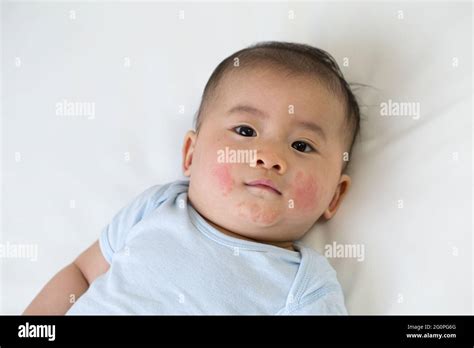 Rash On Asian Skin Hi Res Stock Photography And Images Alamy