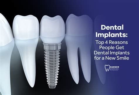 Dental Implants Top 4 Reasons People Get Dental Implants For A New