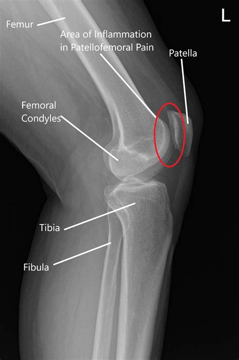 Knee Xray Displays Basic Knee Joint Anatomy Including
