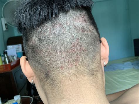40 Bumps In The Back Of Head After Haircut Elliotkeiarra