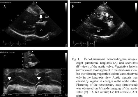 Figure 1 From Infective Endocarditis Of The Aortic Valve In A Border