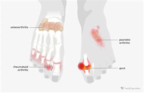 Arthritis In Feet Types Symptoms Treatments And More