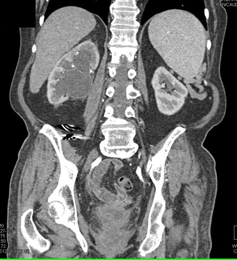 Transitional Cell Carcinoma Of The Right Renal Pelvis And Ureter