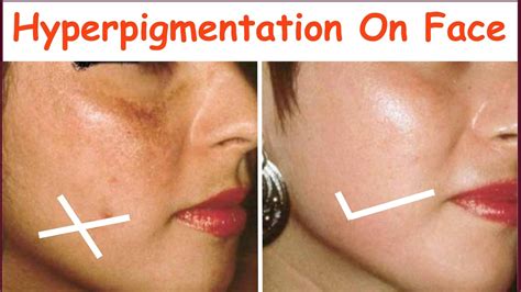 6 Home Remedy For Pigmentation Hyperpigmentation Brown Spots