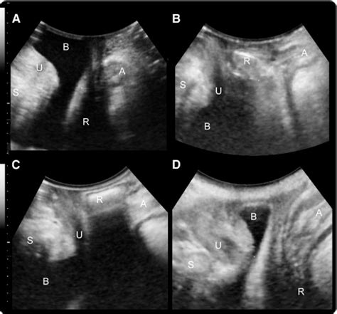 Pelvic Ultrasound Female Hydrosalpinx Radiology Reference Article