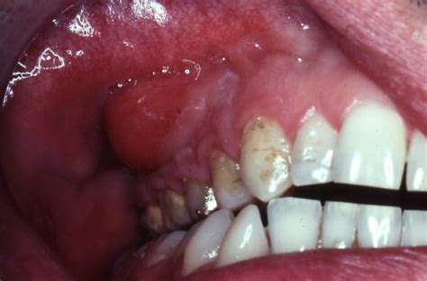 Gallery Dental Abscesscellulitisludwigs Angina Teeth Relief