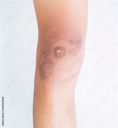 Scar And Blemishes Dark Spots On The Skin Of The Person On The Leg