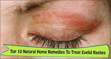 7 Causes And Effective Home Remedies To Get Rid Of Eyelid Rashes