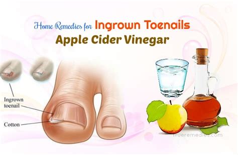 14 Home Remedies For Ingrown Toenails Infection And Fungus