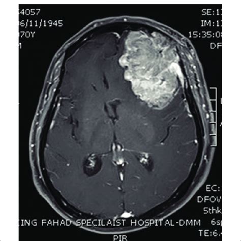 Pdf Brain Metastasis From Chromophobe Renal Cell Carcinoma