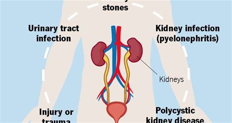 Kidney Pain Causes Diagnosis Treatment What Diseases Cause Kidney