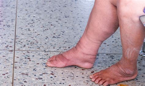 Lymphedema Living With Swelling And Stiffness Nih Medlineplus Magazine