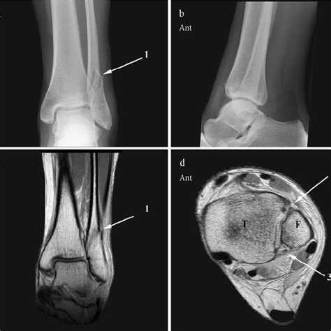 Ap A And Lateral B Radiographs A Transverse Fibular Malleolar