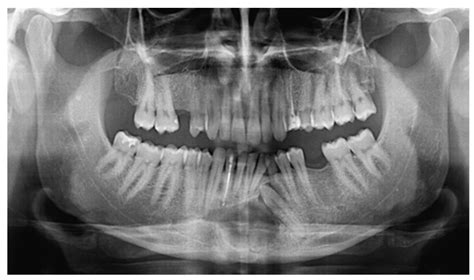 Oral Squamous Cell Carcinoma Radiographic