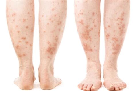 Leg Rash Symptoms Causes Treatments