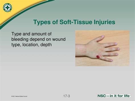 Ppt Soft Tissue Injuries Powerpoint Presentation Free Download Id5017949