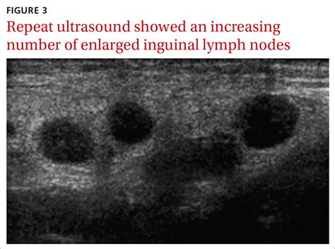Swollen Lymph Nodes In Groin
