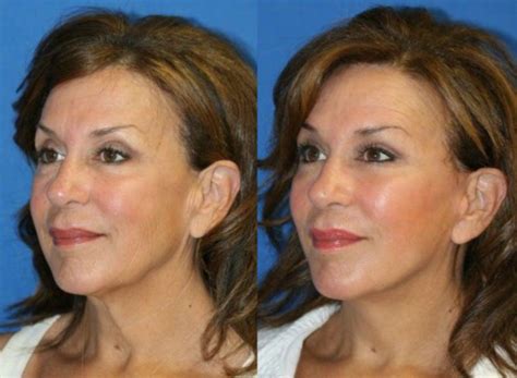 Dr Karam San Diego California Fat Transfer And Facelift Plastic