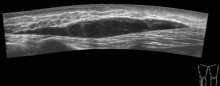 Post Traumatic Soft Tissue Cyst Leg Radiology Case Radiopaedia Org