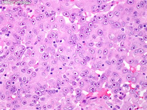 We offer treatment and prognosis assistance. Webpathology.com: A Collection of Surgical Pathology Images