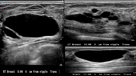 Breast Imaging Cases Mammoguide Learn Breast Imaging