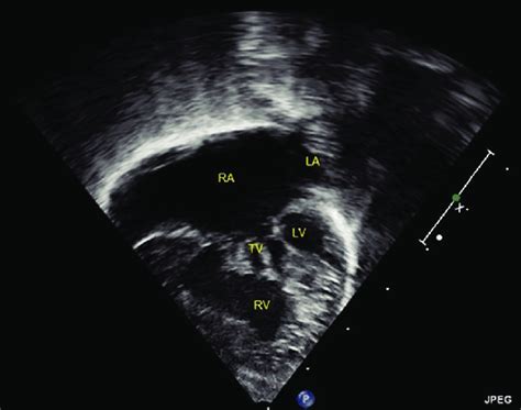 Transthoracic Echocardiography Four Chamber View Is Showing Mitral