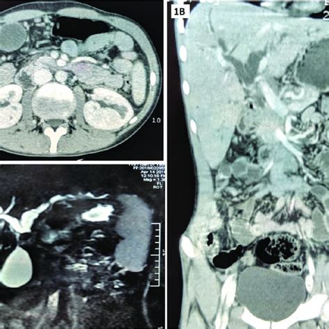 Contrast Enhanced Abdominal Computed Tomography Scan Showing Dilation