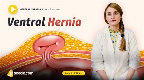 Ventral Hernia General Surgery Video Lecture Doctors V Learning Youtube