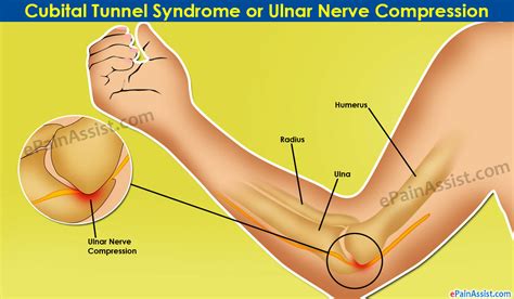 Cubital Tunnel Syndrome Or Ulnar Nerve Compressionsymptomscauses