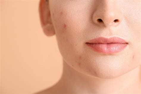 8 Myths About Acne Debunked Dermatologists And Aesthetic And Wellness Clinic Located In Arcata And