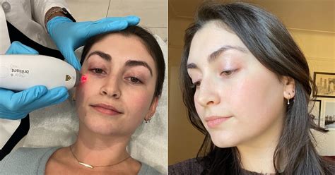 Clear Brilliant Laser Treatment Review With Photos Popsugar Beauty