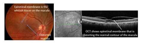 Retina Consultants Of Boston Preserving The T Of Sight
