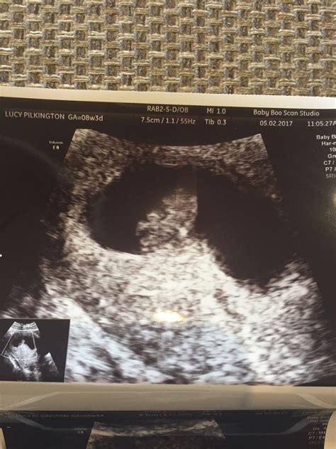 Ultrasound Scans At 8 Weeks Pics