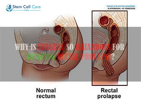 Why Is Surgery So Hazardous For Treating Rectal Prolapse Home
