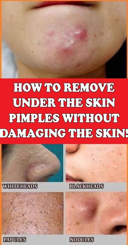 How To Remove Under The Skin Pimples Without Damaging Your Skin