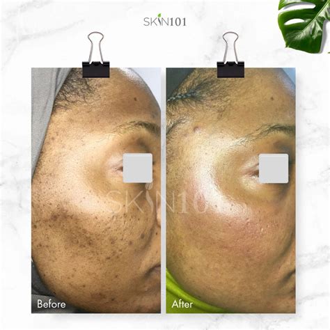 Post Inflammatory Hyperpigmentation Pih From Acne Before And After