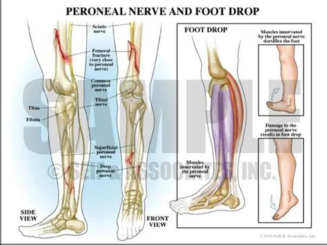 What Is Foot Drop And What Causes This Peroneal Nerve
